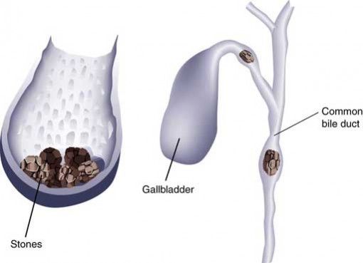 Gall Bladder Stone Indian Diet Recipes