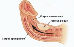 La maladie de Peyronie