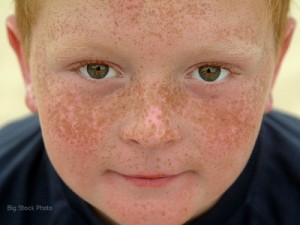 Hand Freckles