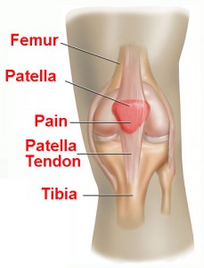 Surgery To Correct Patellar Femoral Syndrome