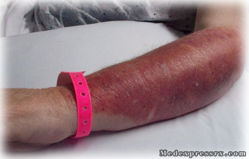 Cellulitis 300x192 Bacterial skin infections Causes, Types and ...